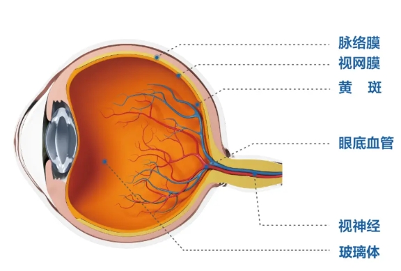 高度近视眼黄斑病变