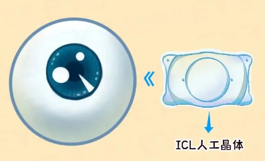 &ldquo;为什么做近视手术？&rdquo;理由就这一个！